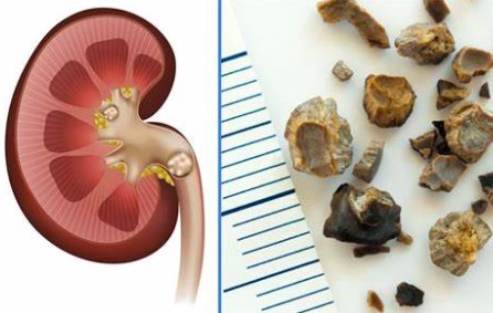 Böbrek taşları sırasında beslenme 1